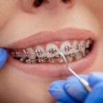 Questions to Ask Before Visiting an Orthodontist in Surrey