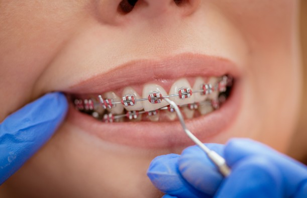 Questions to Ask Before Visiting an Orthodontist in Surrey