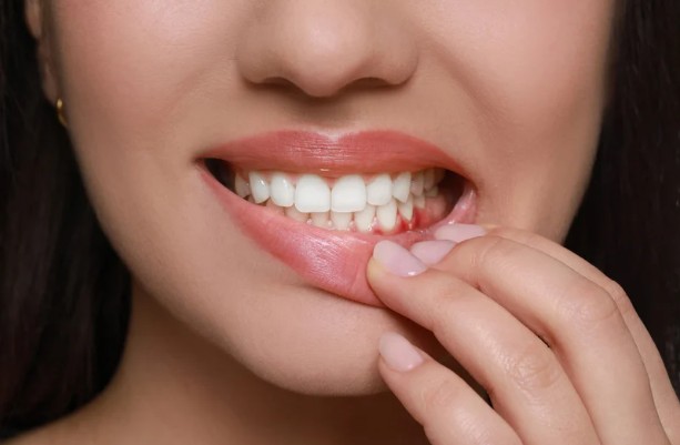 Bleeding Gums